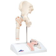 3B Scientific Anatomical Model - Femoral Fracture and Hip Osteoarthritis - Includes 3B Smart Anatomy