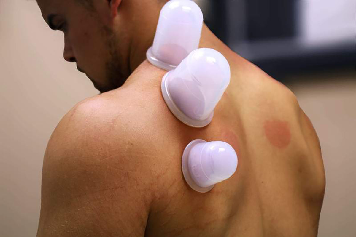 HawkGrips Cupping Set