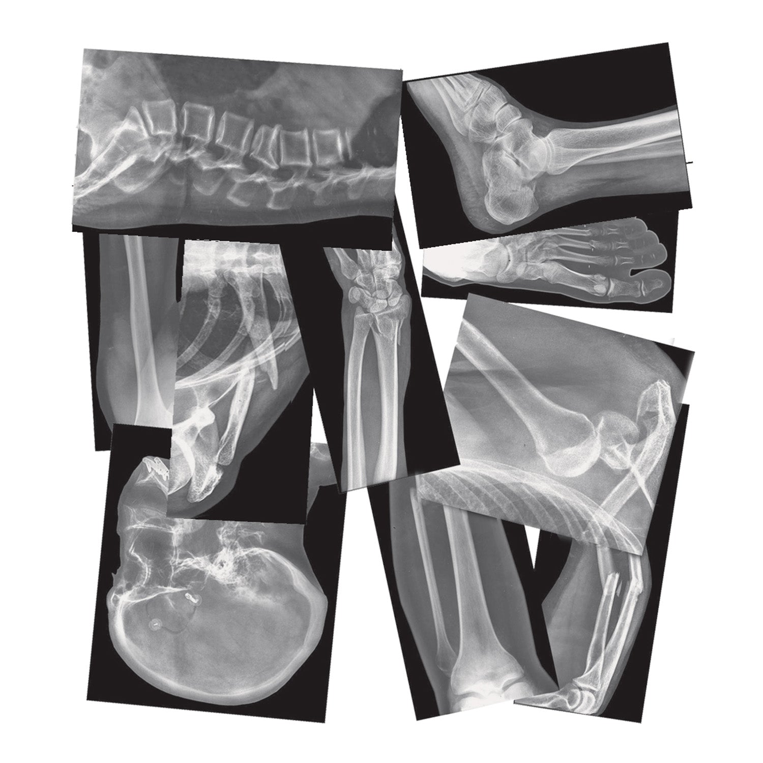 Broken Bones X-Ray Set, Pack of 15