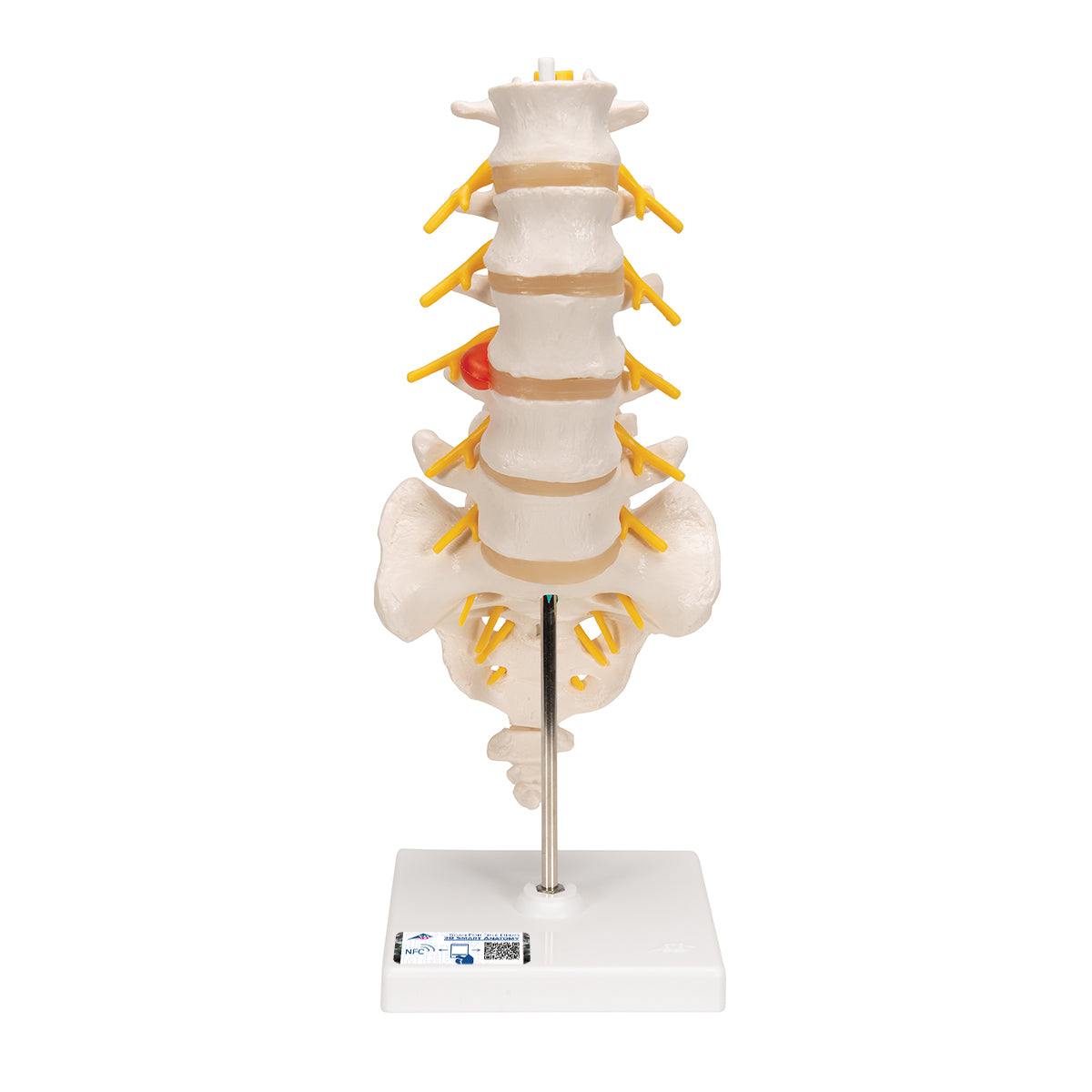 Human Lumbar Spinal Column Model with Dorso-Lateral Prolapsed Intervertebral Disc