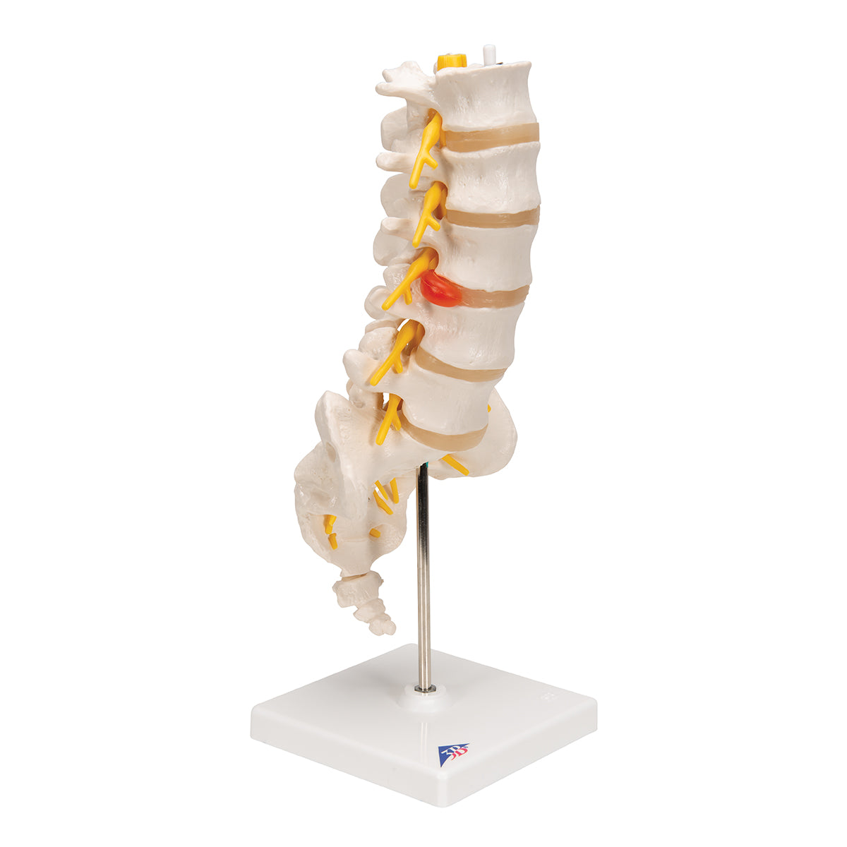 Human Lumbar Spinal Column Model with Dorso-Lateral Prolapsed Intervertebral Disc