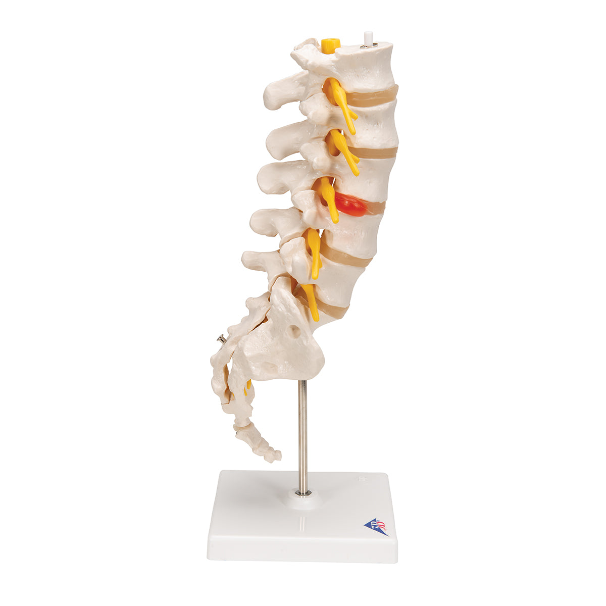 Human Lumbar Spinal Column Model with Dorso-Lateral Prolapsed Intervertebral Disc