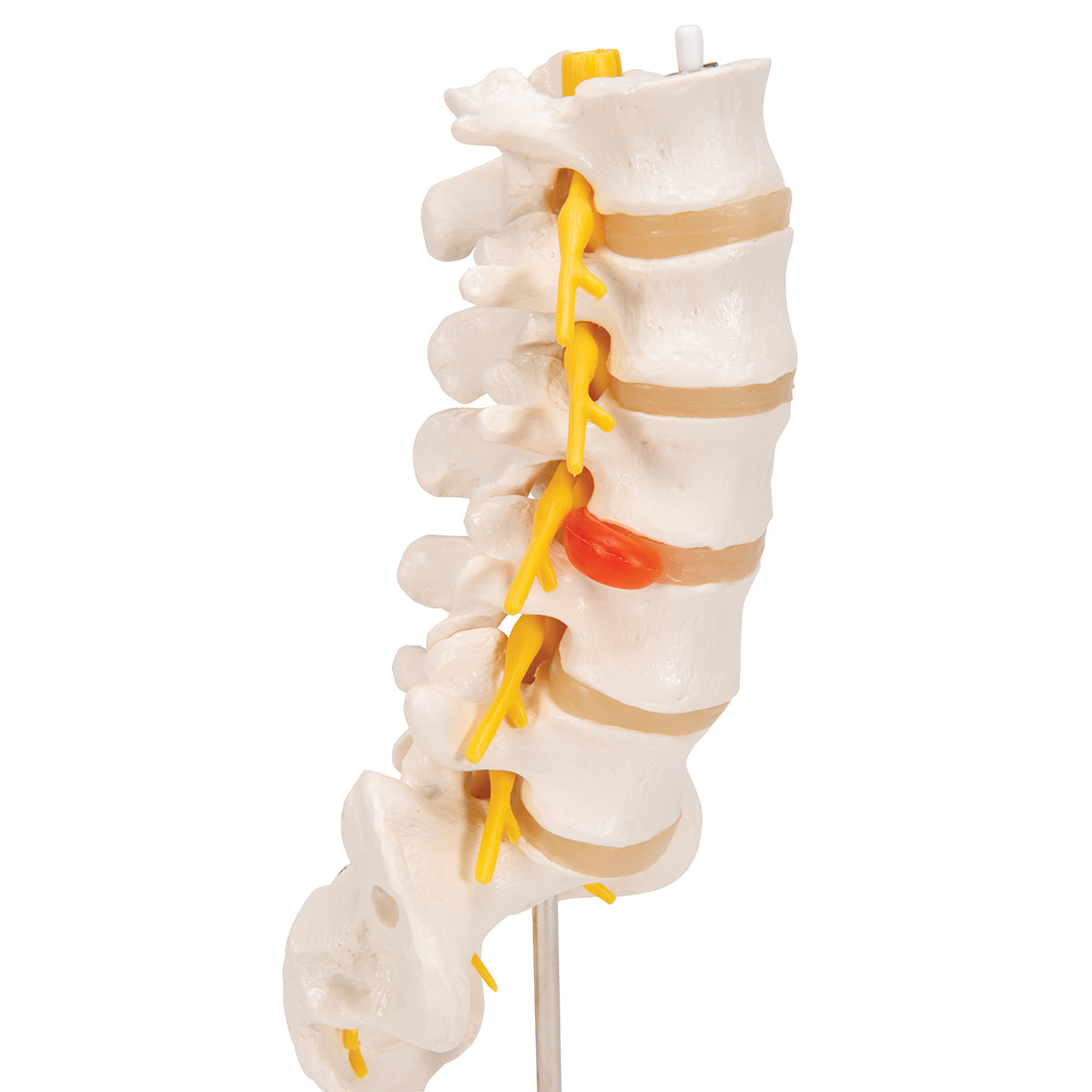 Human Lumbar Spinal Column Model with Dorso-Lateral Prolapsed Intervertebral Disc