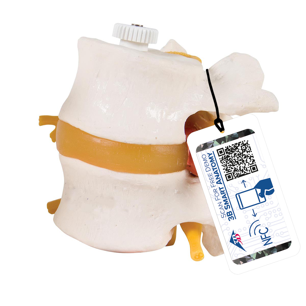2 Human Lumbar Vertebrae with Prolapsed Disc, Flexibly Mounted