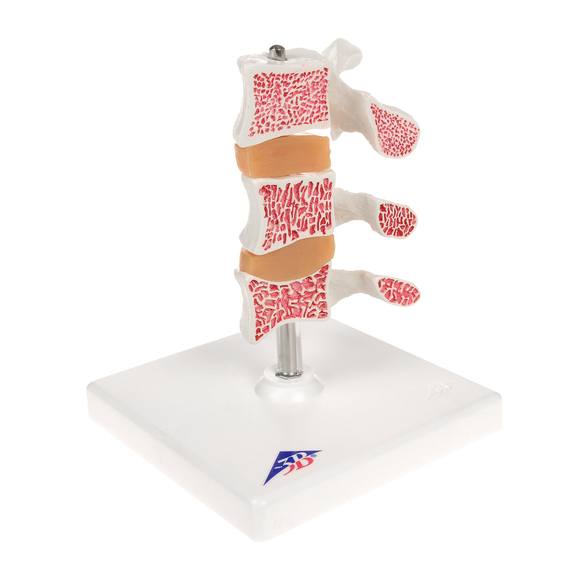 Deluxe Human Osteoporosis Model (3 Vertebrae with Discs ), Removable on Stand