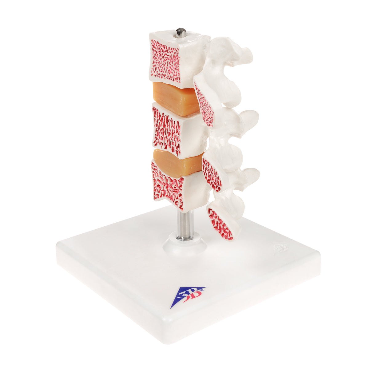 Deluxe Human Osteoporosis Model (3 Vertebrae with Discs ), Removable on Stand