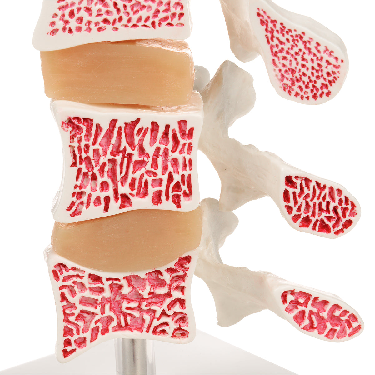 Deluxe Human Osteoporosis Model (3 Vertebrae with Discs ), Removable on Stand