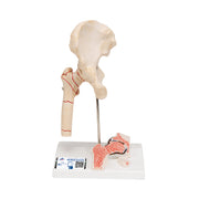 Human Femoral Fracture & Hip Osteoarthritis Model