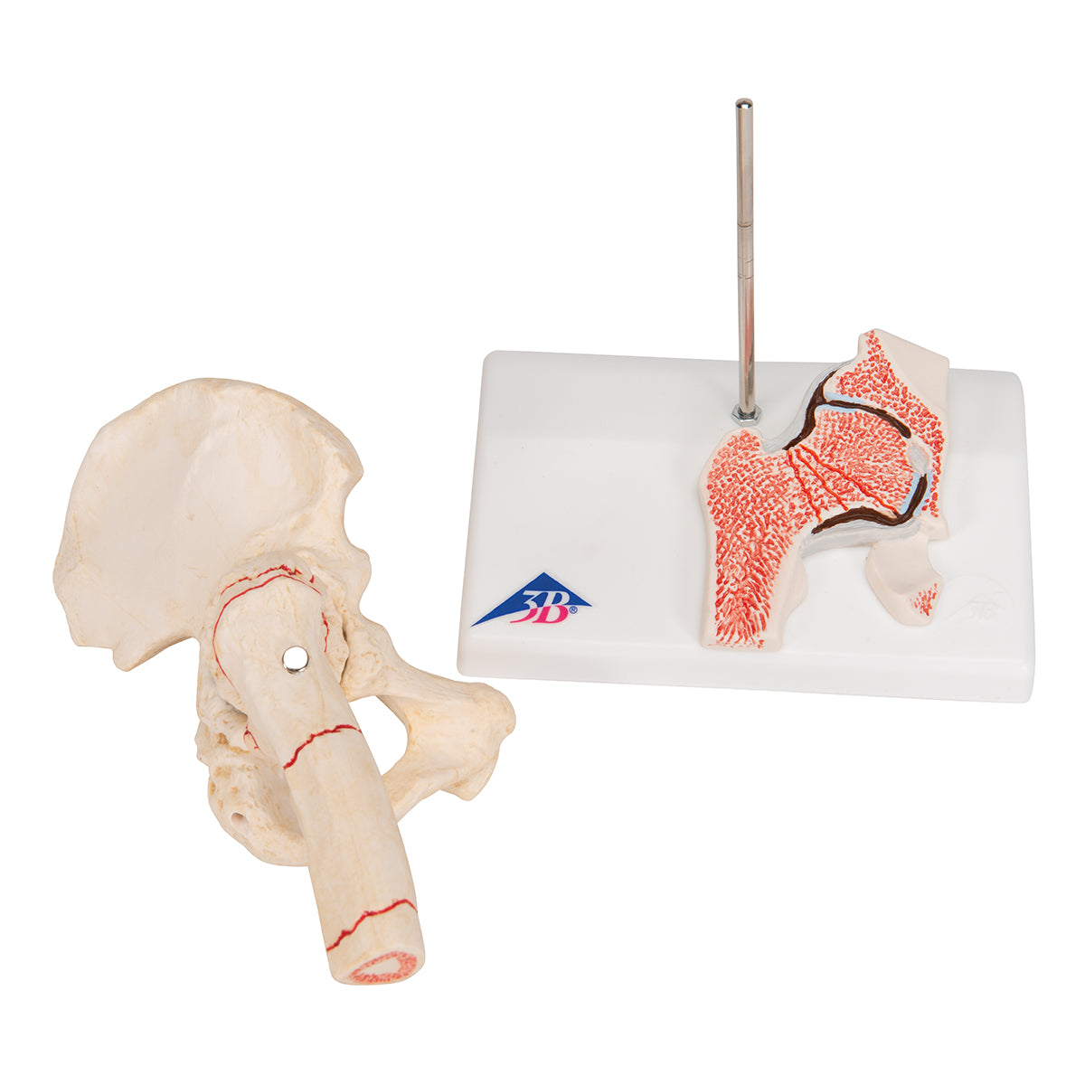 Human Femoral Fracture & Hip Osteoarthritis Model