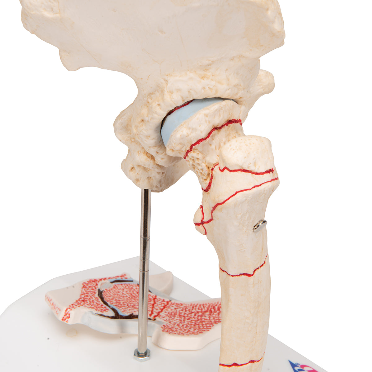 Human Femoral Fracture & Hip Osteoarthritis Model