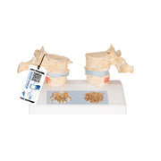 Osteoporosis Didactic Model