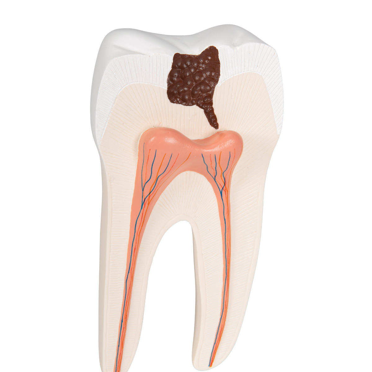 Lower Twin-Root Molar with Cavities Human Tooth Model, 2 part