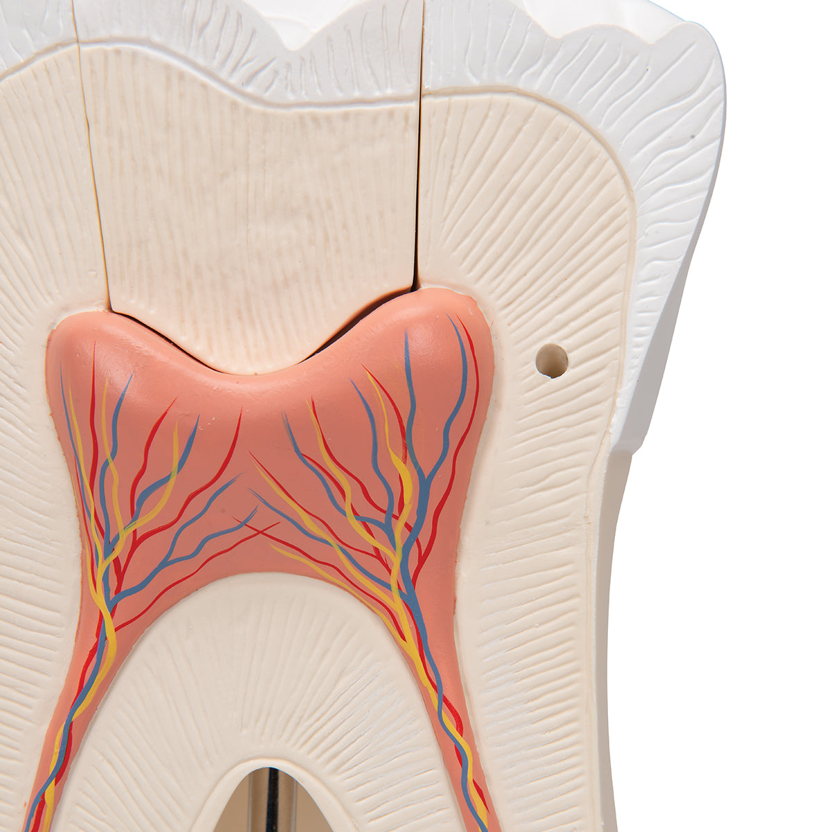 Giant Molar with Dental Cavities Human Tooth Model, 15 times Life-Size, 6 part