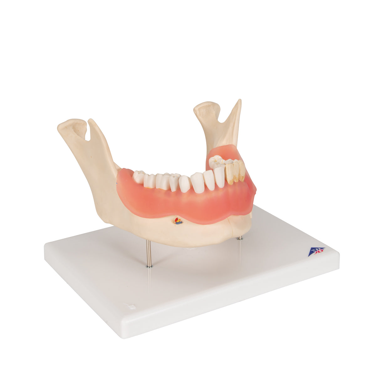 Dental Disease Model, Magnified 2 times, 21 parts