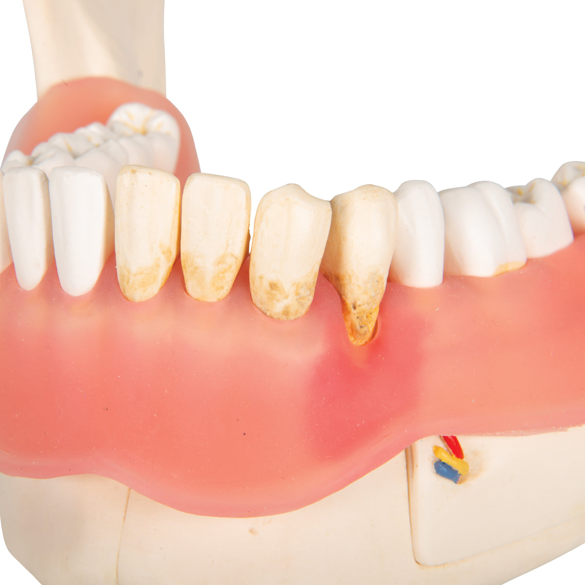 Dental Disease Model, Magnified 2 times, 21 parts