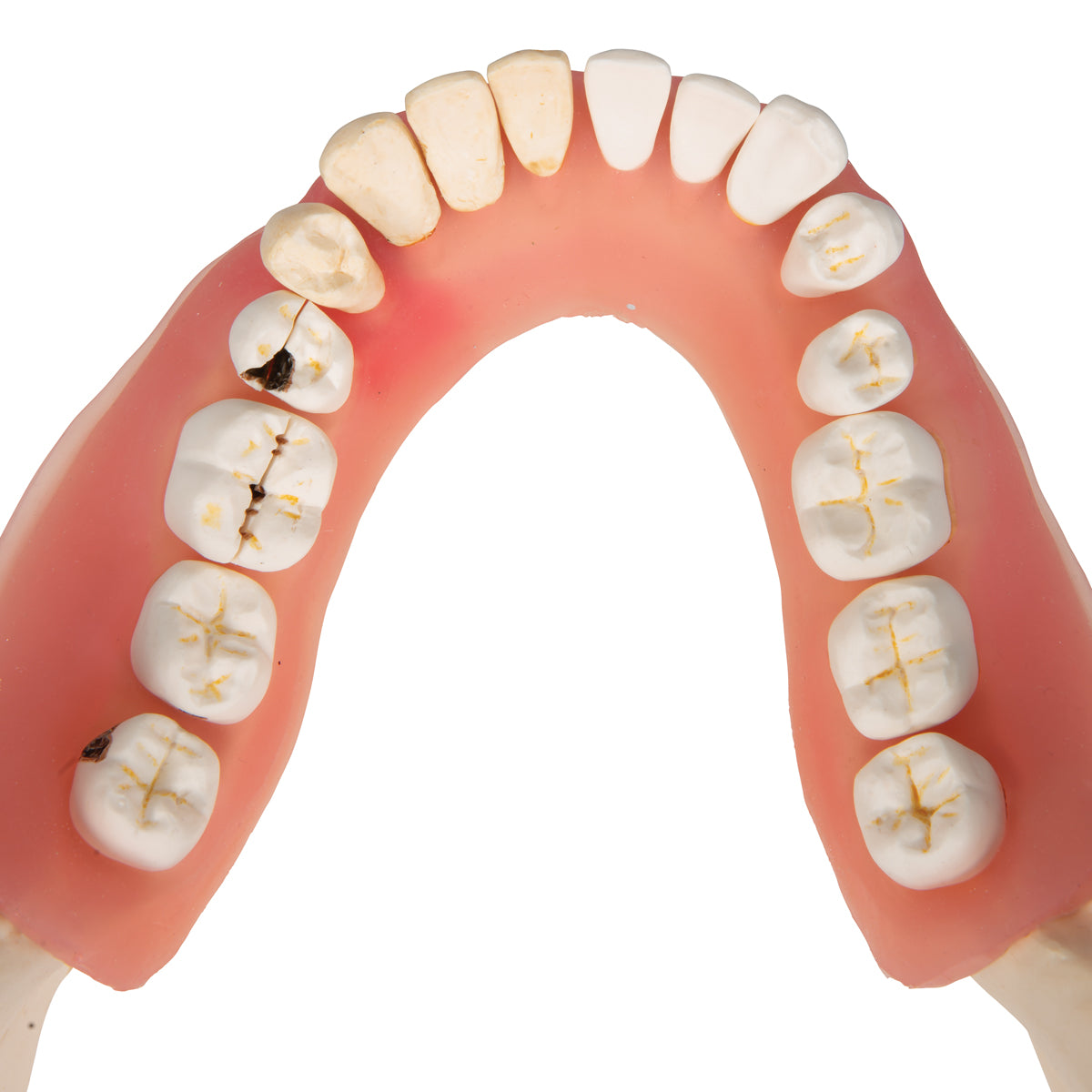 Dental Disease Model, Magnified 2 times, 21 parts