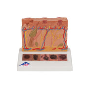 Skin Cancer Model with 5 stages, 8 times magnified