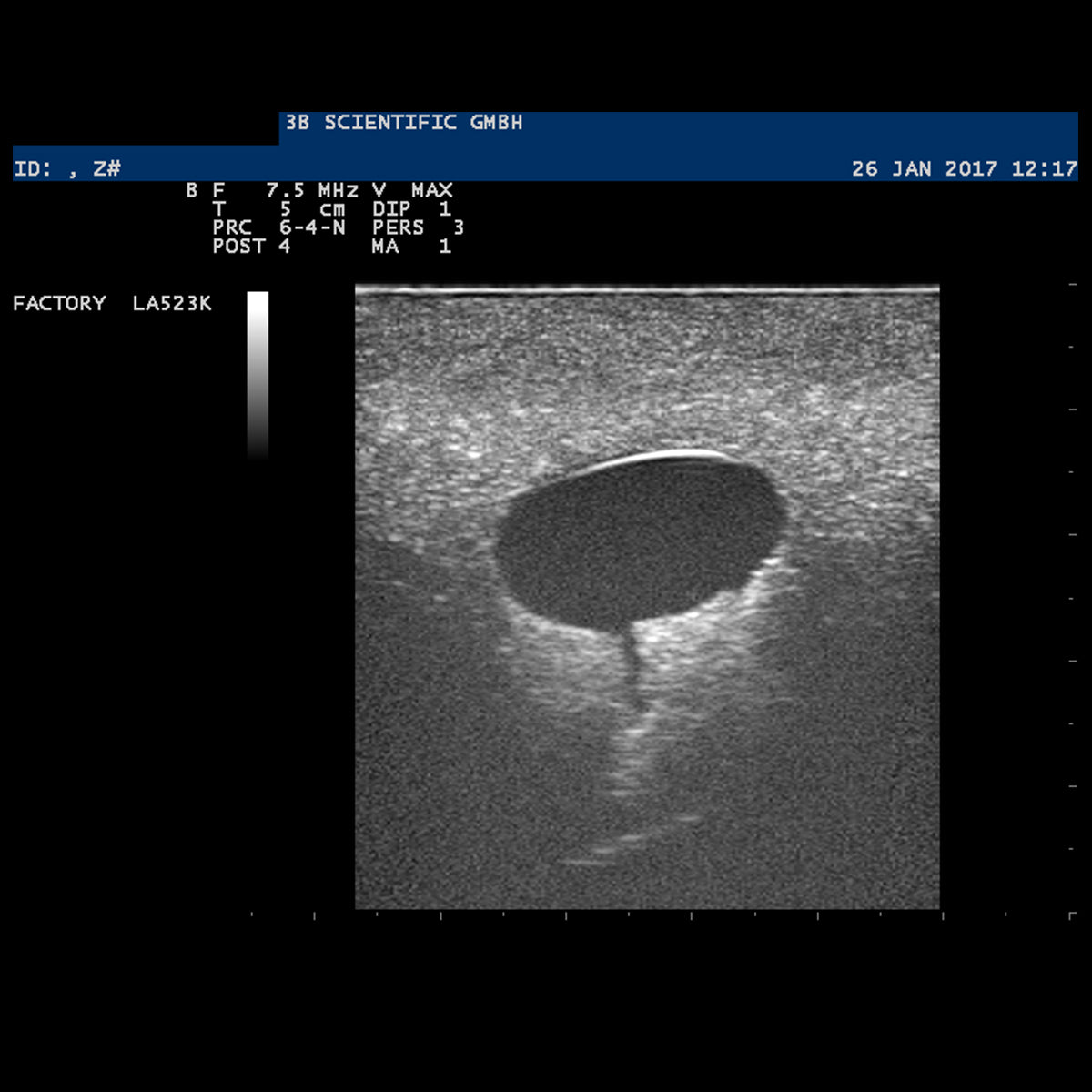 SONOtrain Breast Model with Cysts, Light Skin