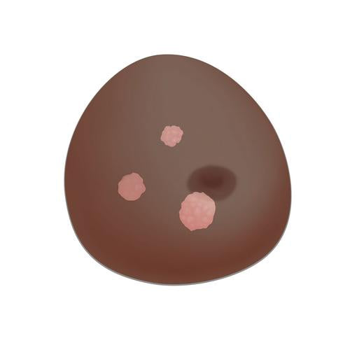 SONOtrain™ Breast with Tumours, Dark