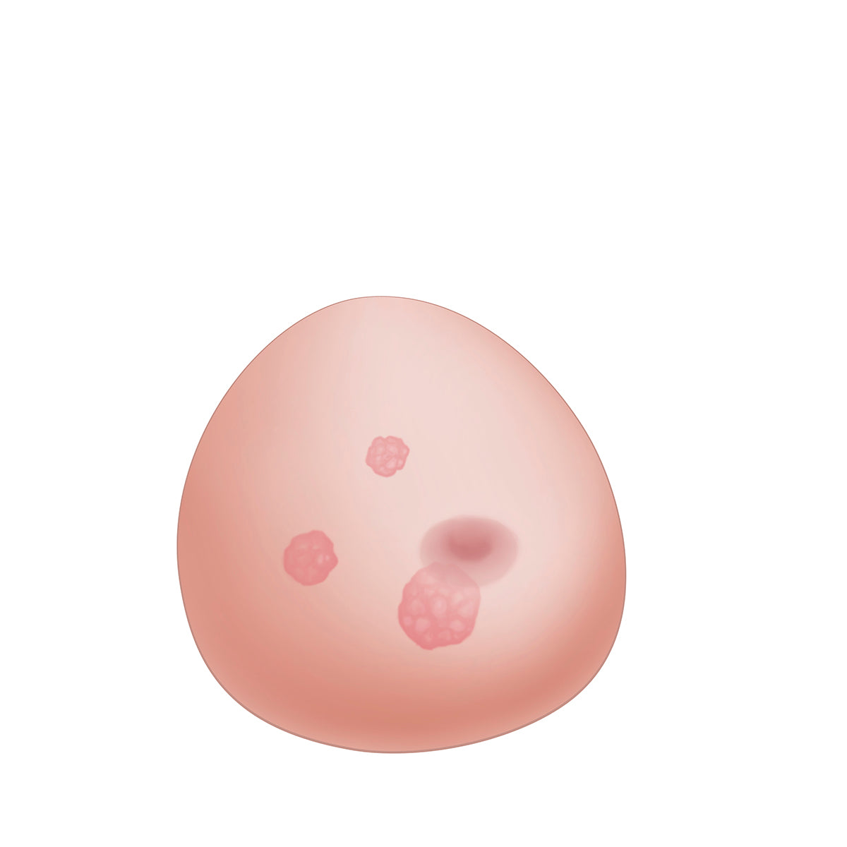 SONOtrain Breast model with tumours, Light Skin