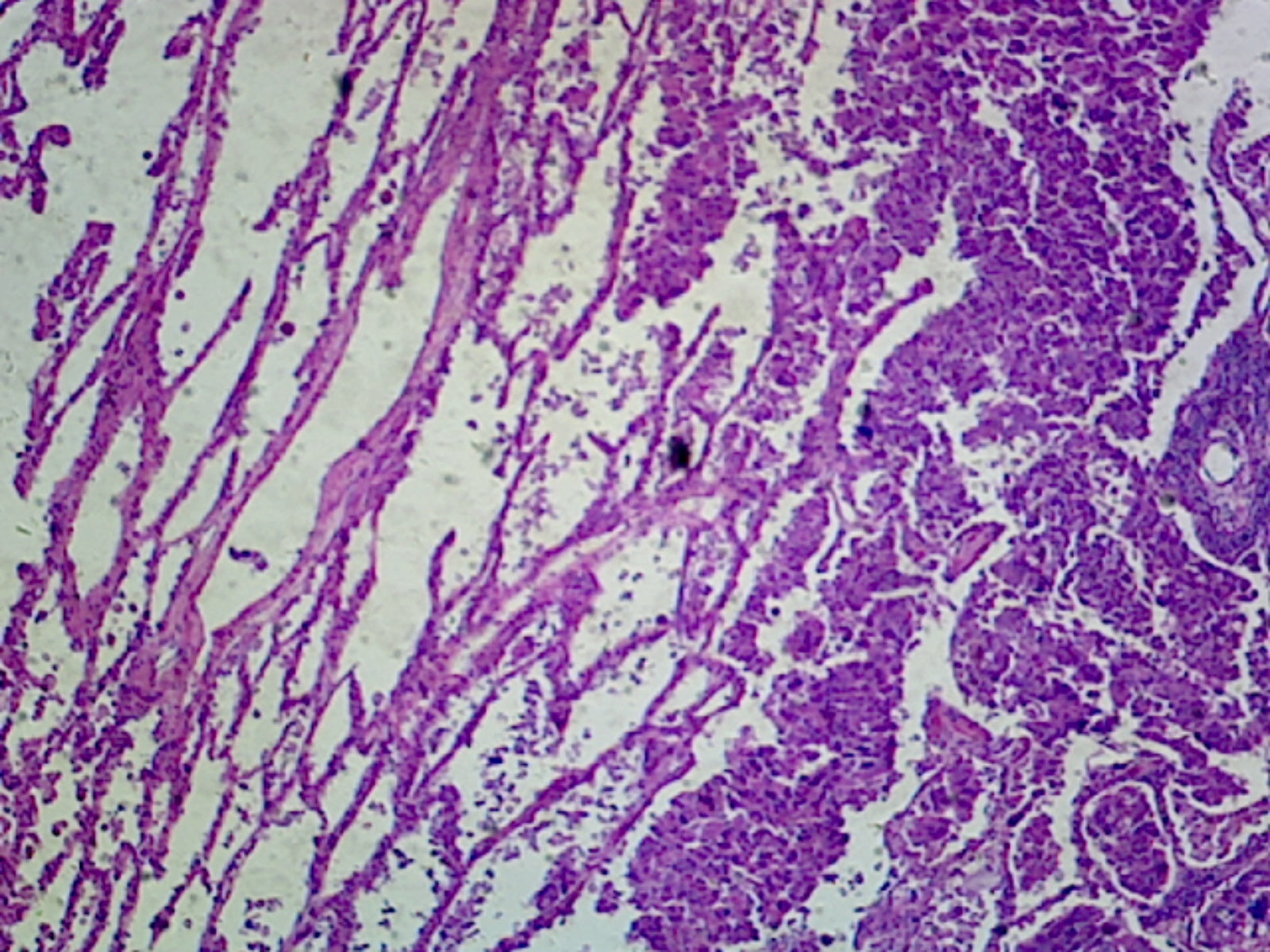 Microscope Slide, Bronchogenic Carcinoma of the Lung Section; H&E stain