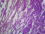 Microscope Slide, Bronchogenic Carcinoma of the Lung Section; H&E stain