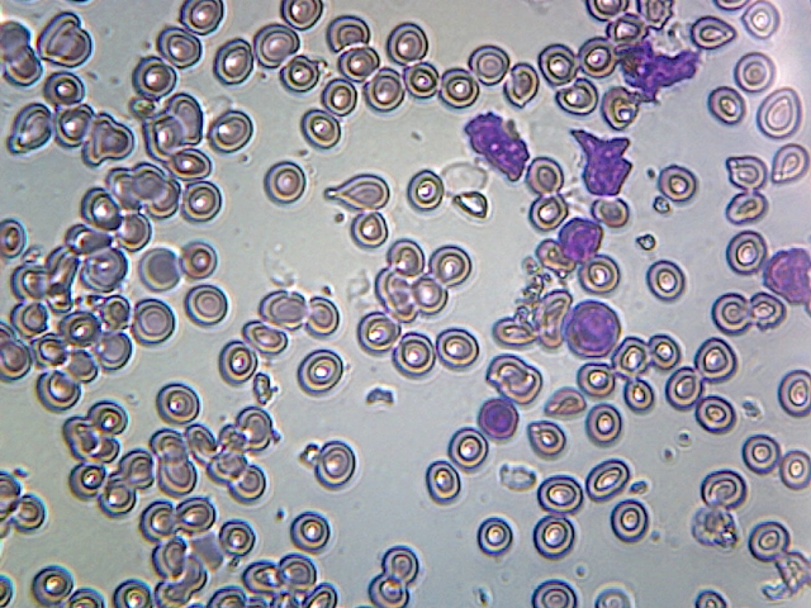 Microscope Slide, Acute Lymphatic Leukemia Smear from blood, GS Stain Showing Abnormal Lymphocytes