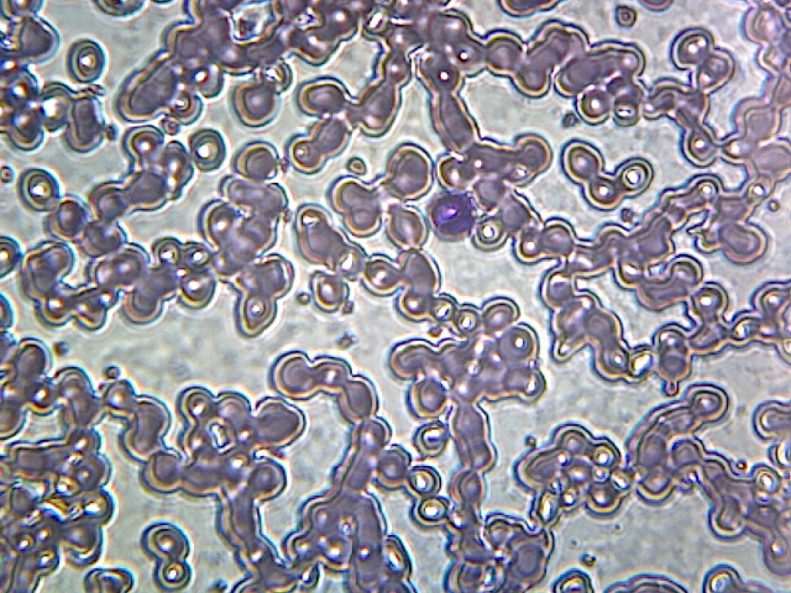 Microscope Slide, Iron-deficient Anemia Blood smear, GS stain, Human, showing peripheral blood film with small, pale red blood cells
