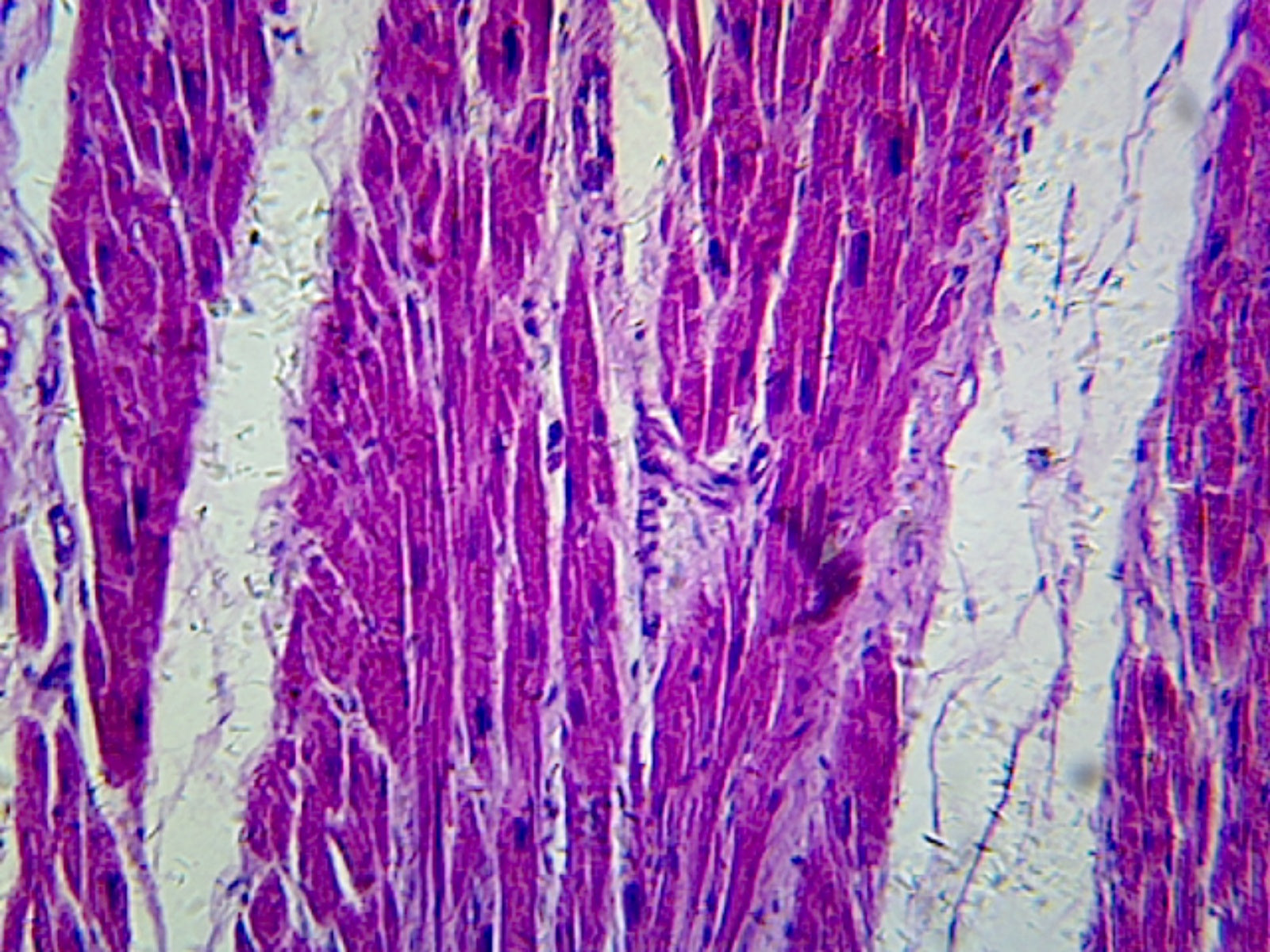 Microscope Slide, Myocardial infarct, sec. H/E stain, showing damaged muscle
