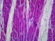 Microscope Slide, Myocardial infarct, sec. H/E stain, showing damaged muscle