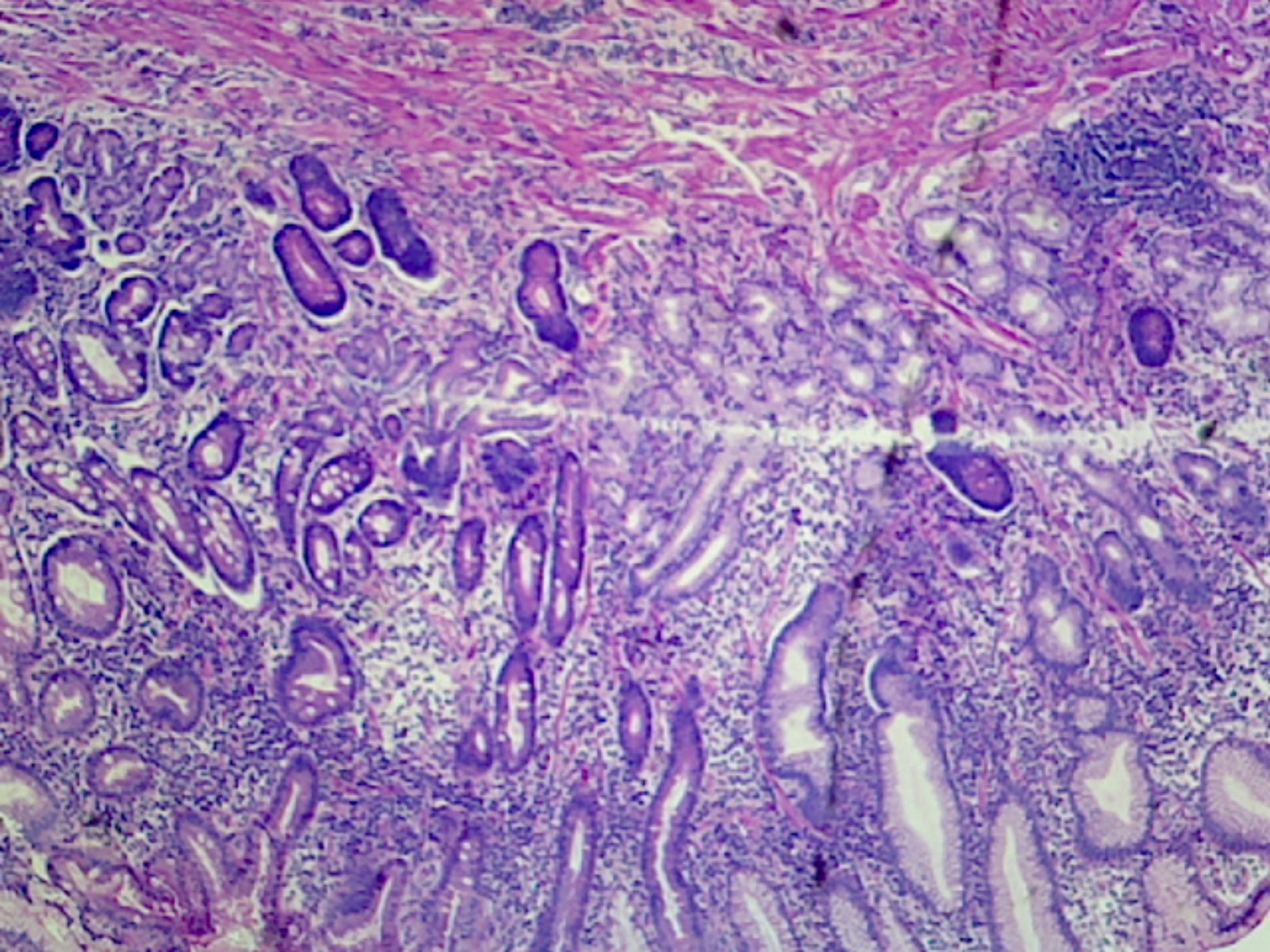 Microscope Slide, Gastric Ulcer; Section; H&E stain; Human