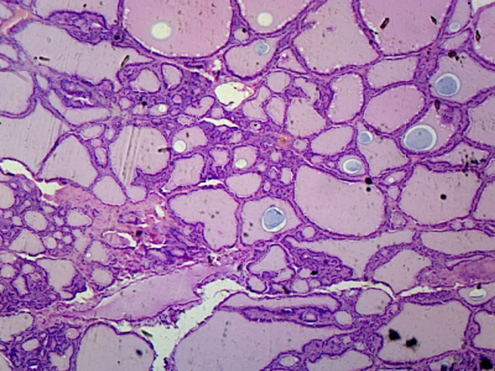 Microscope Slide, Goiter; section; H&E stain; Human, showing pathological thyroid gland