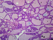 Microscope Slide, Goiter; section; H&E stain; Human, showing pathological thyroid gland