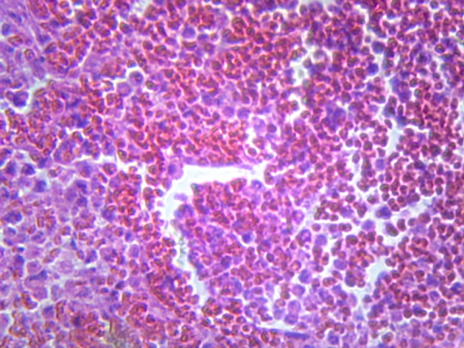 Microscope Slide, Pneumonia; Section; H&E stain; Human