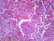 Microscope Slide, Pneumonia; Section; H&E stain; Human