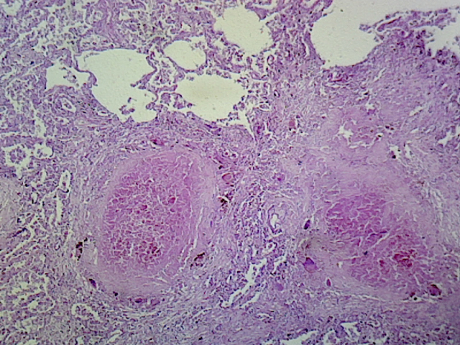 Microscope Slide, Lung Tuberculosis, sec. H/E stain Human