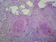 Microscope Slide, Lung Tuberculosis, sec. H/E stain Human