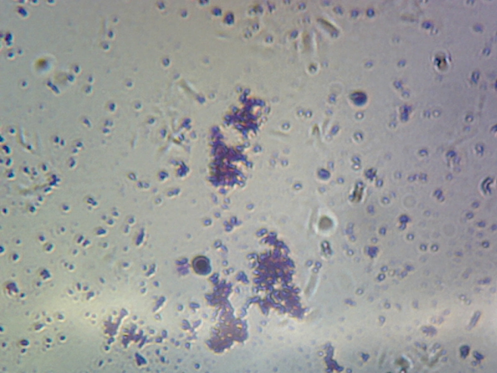 Microscope Slide, Coccus, smear; Mixed Diplococci, Hemophilus Gram Negative, and Streptococcus pneumoniae Gram Positive