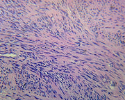 Microscope Slide, Uterus Section Human, showing Fibroid Tumor H&E stain