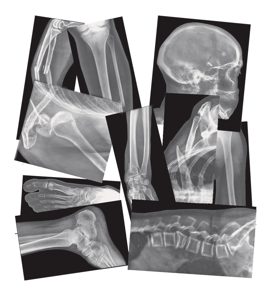 Broken Bones X-Rays  15/pkg