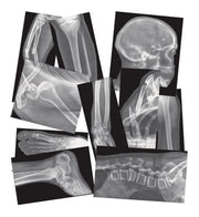 Broken Bones X-Rays  15/pkg