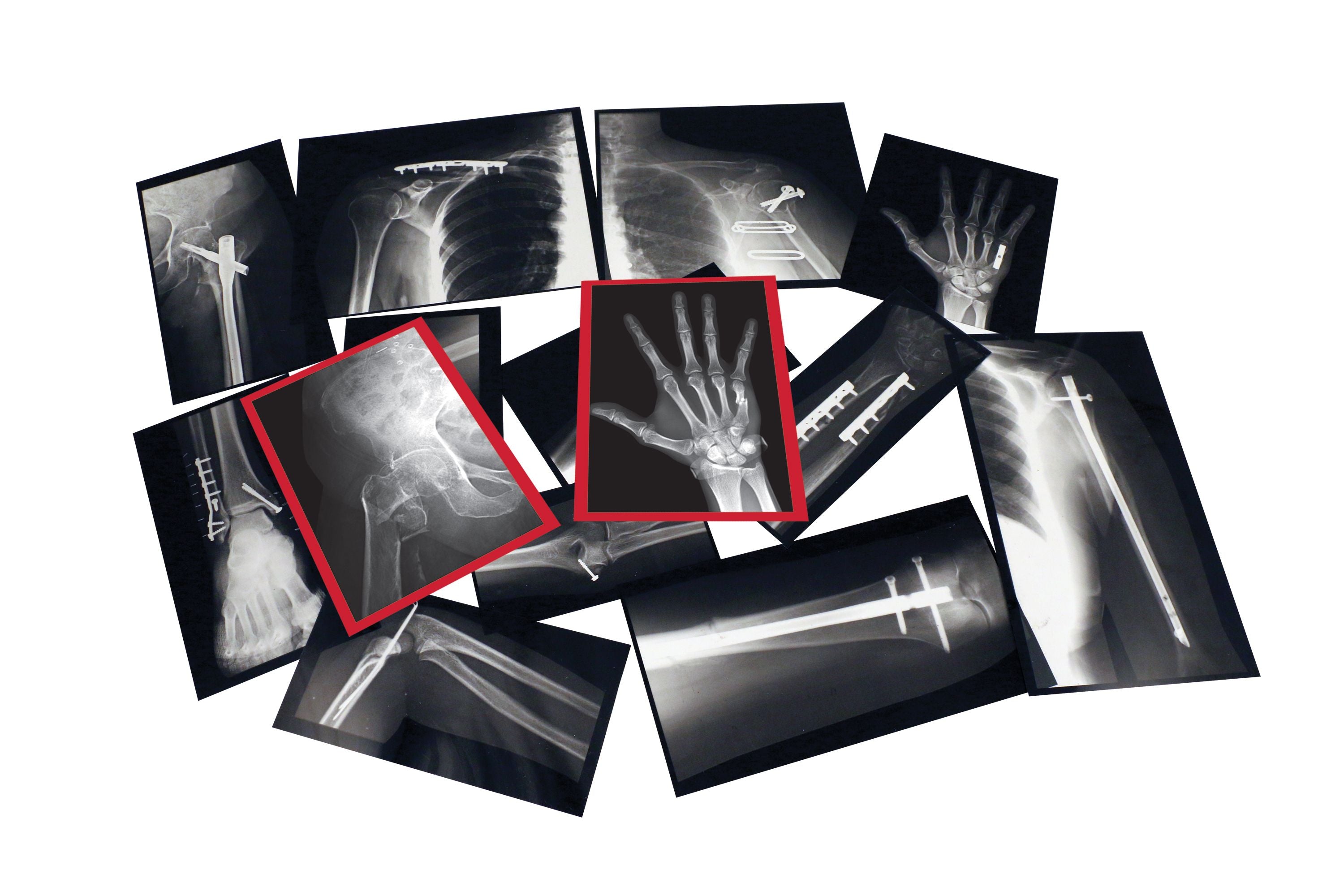 Fixed Bones X-Rays