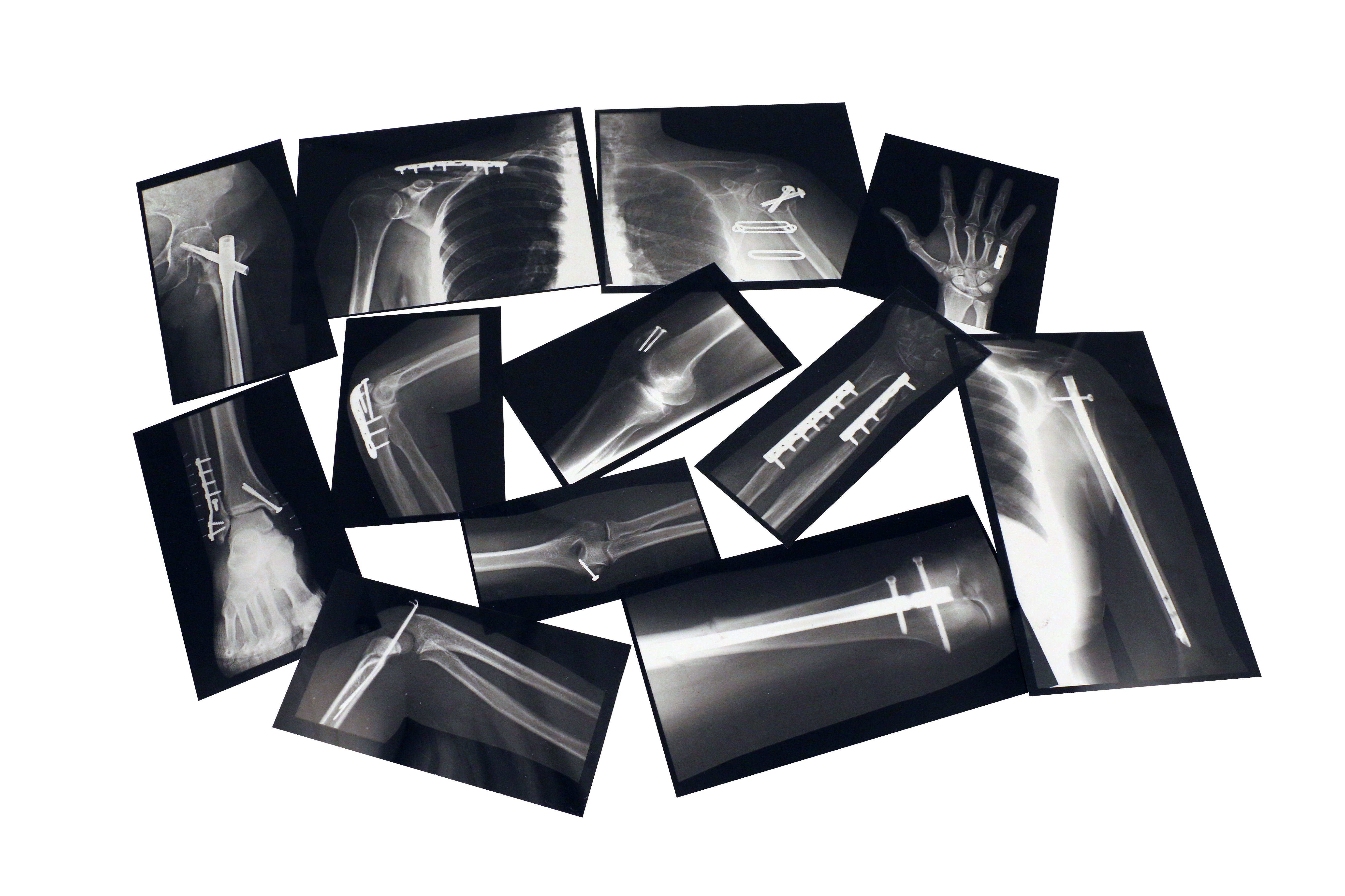 Fixed Bones X-Rays