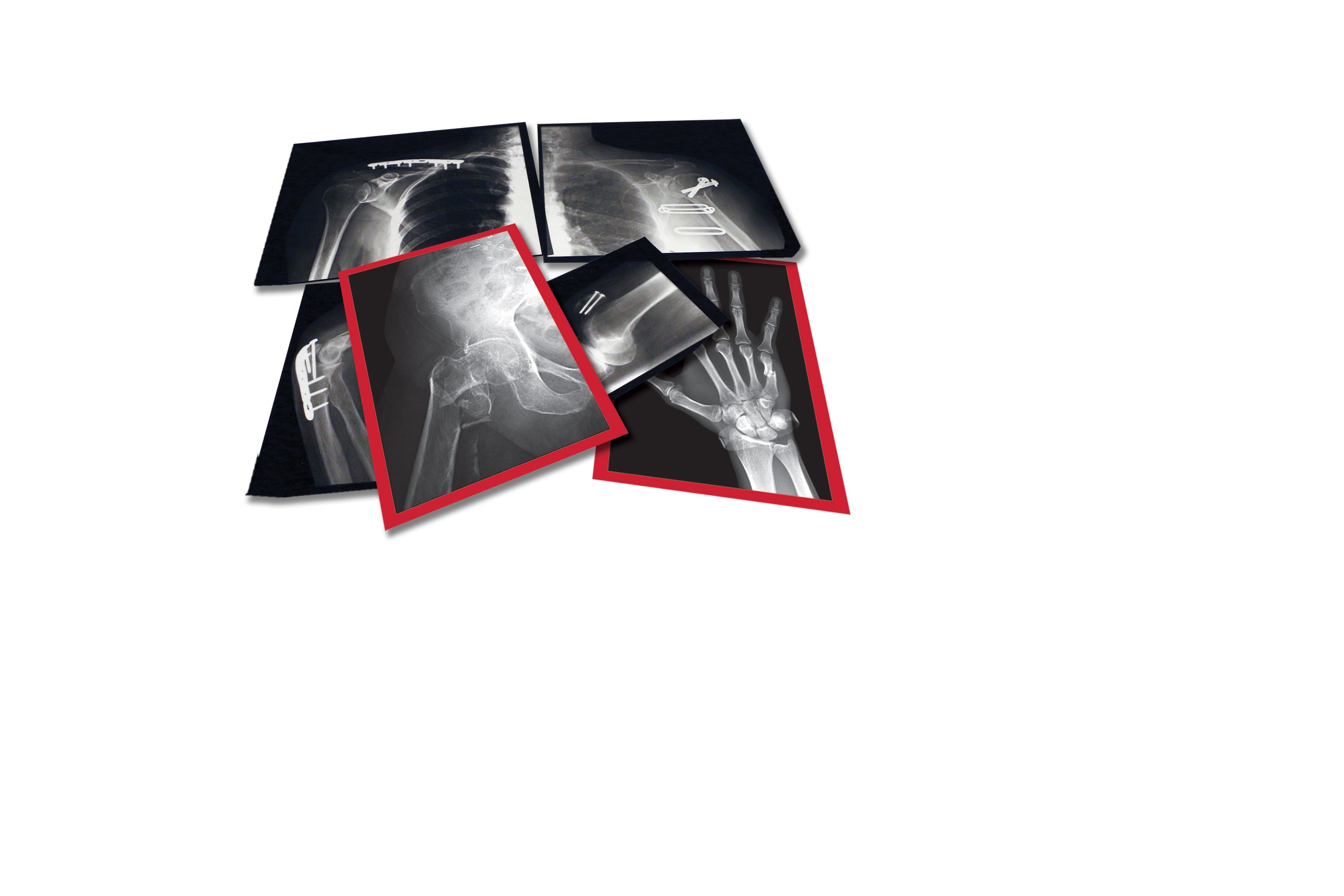 Fixed Bones X-Rays