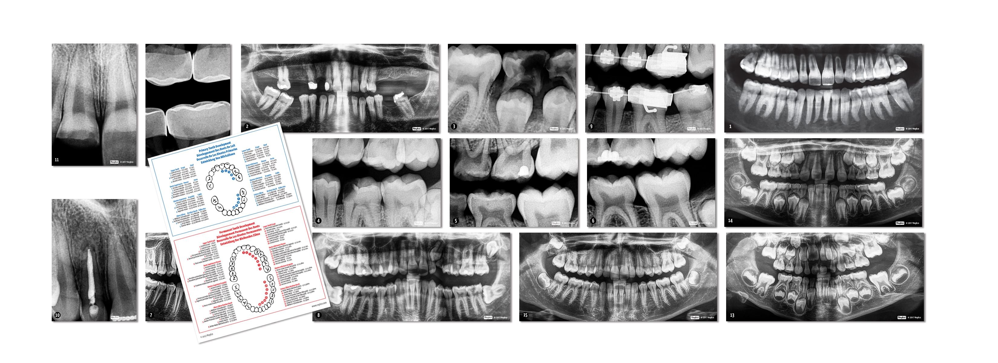 Dental X-Rays