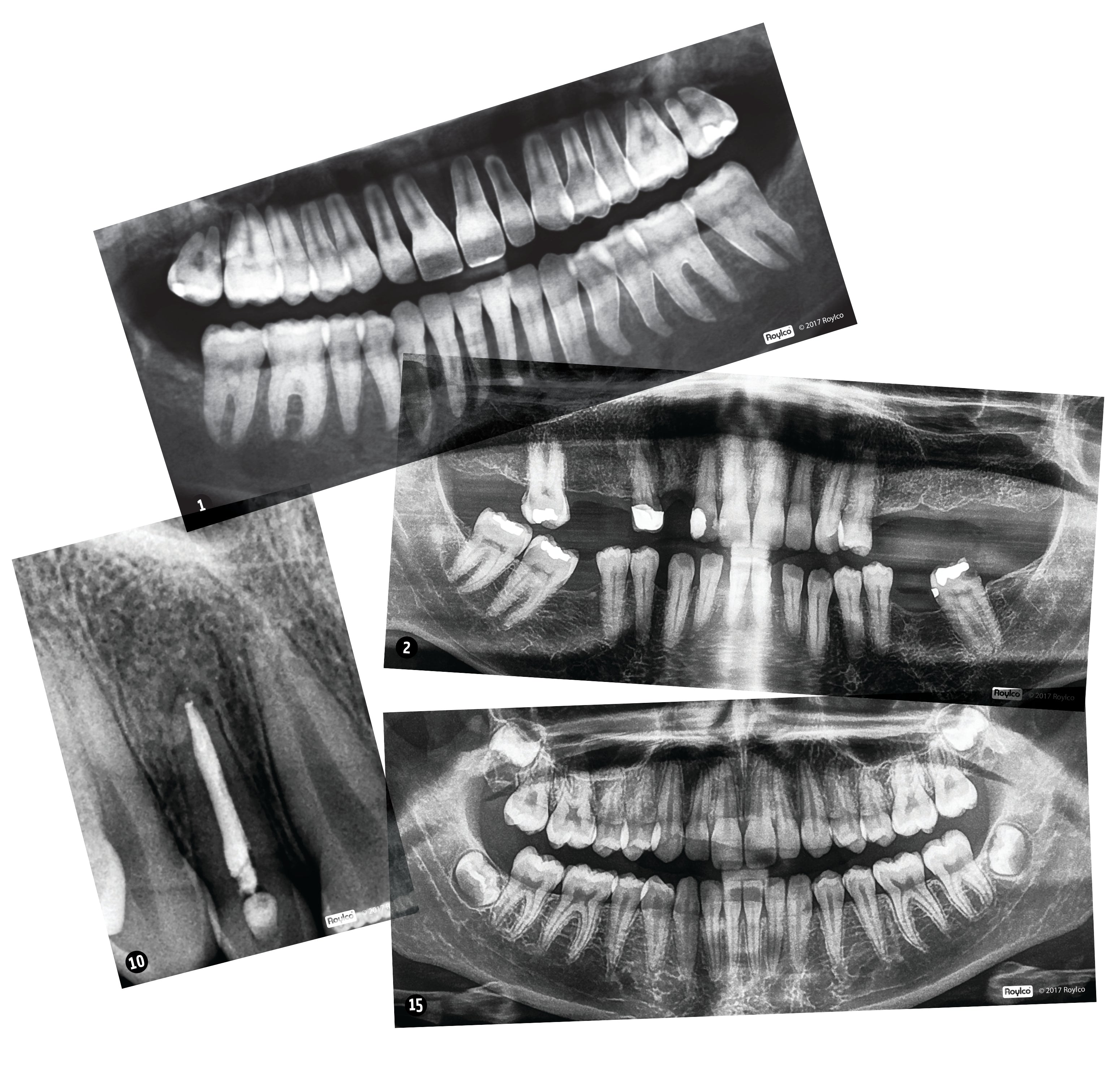 Dental X-Rays