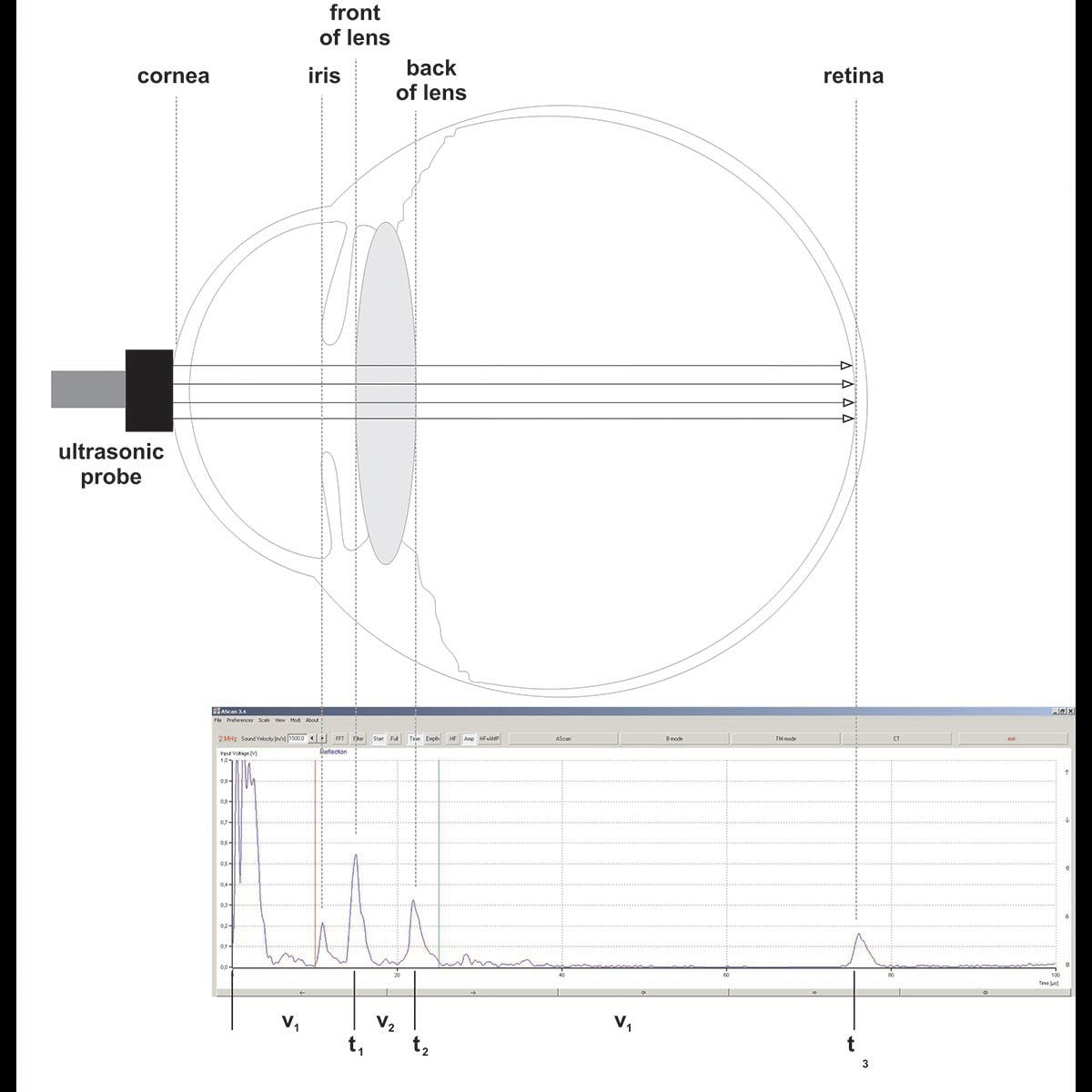 Model Eye for Ultrasonic Biometry