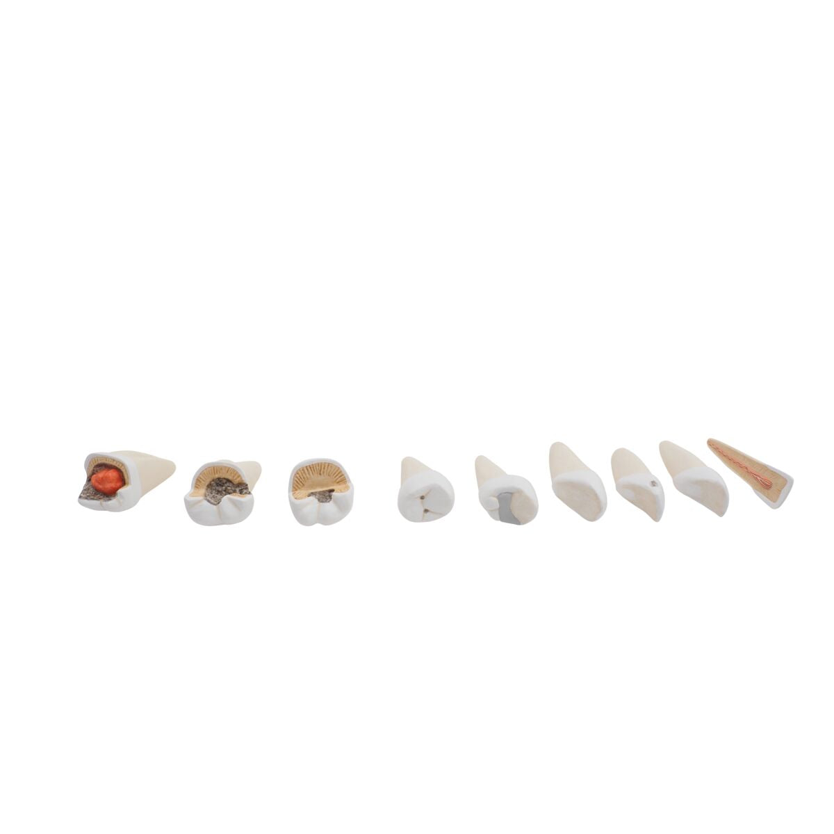 Comprehensive Lower Jaw Model (Left Half) with Diseased Teeth, Nerves, Vessels & Glands, 19 part