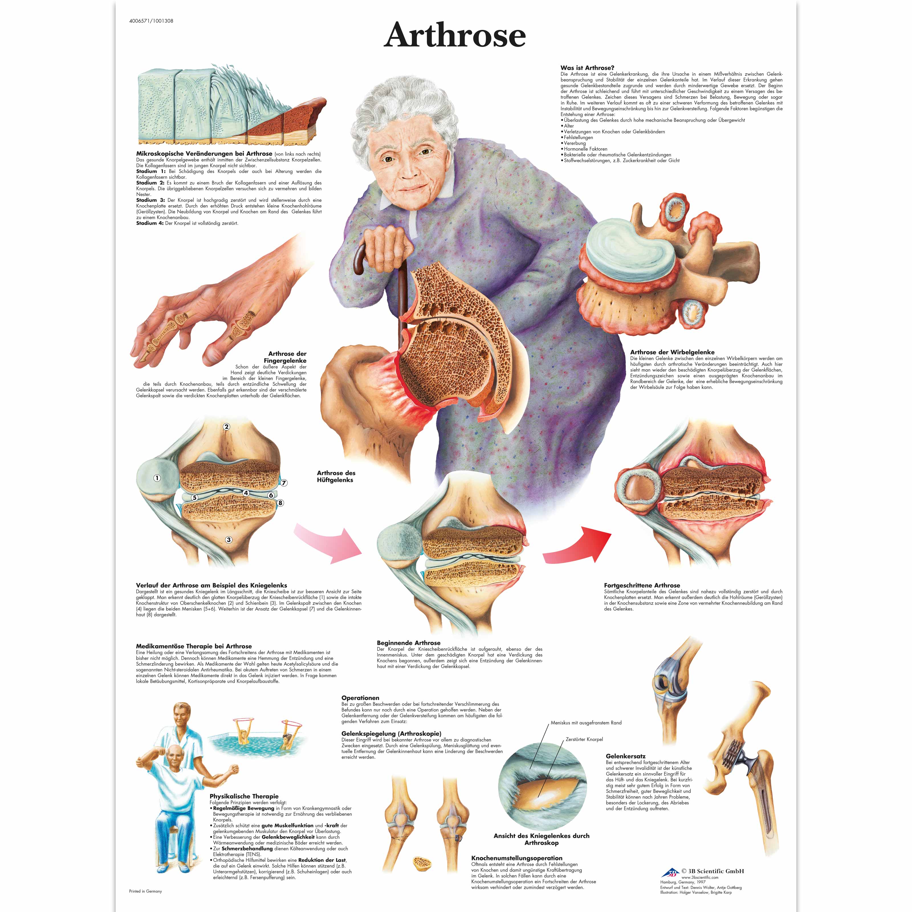 Arthrose