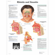 Rhinitis und Sinusitis